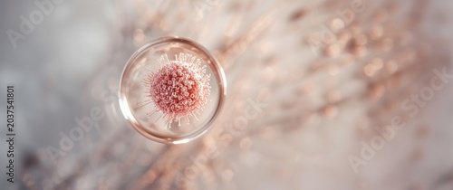 Bone marrow aspirate photomicrograph emphasizing abnormal blast cell population in leukemia