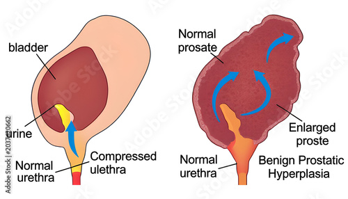 Benign prostatic hyperplasia bph and urinary system anatomy