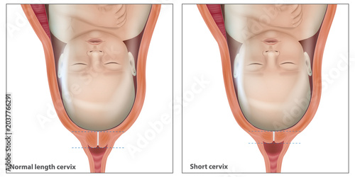 Medical Illustration of Normal and Short Cervix During Pregnancy With Fetal Head Presentation. Prenatal Medical Infographic of Cervical Insufficiency and Shortened Cervix During Late Pregnancy