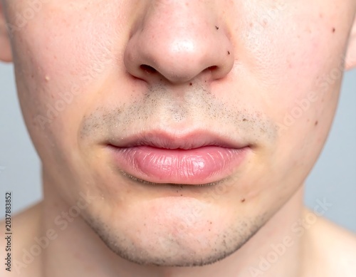 Close-up of a fair-skinned person's lower face. Focus is on lips, nose and mouth. Small moles are visible. The skin texture is clear and smooth