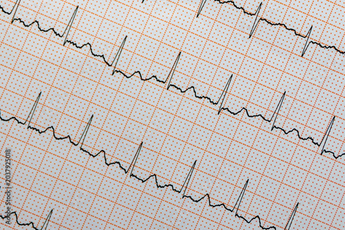 An electrocardiogram (ECG) tracing printed on standard grid paper