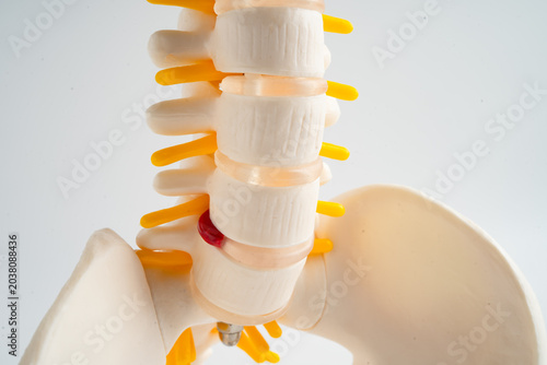 Lumbar spine displaced herniated disc fragment, spinal nerve and bone. Model for treatment medical in the orthopedic department.