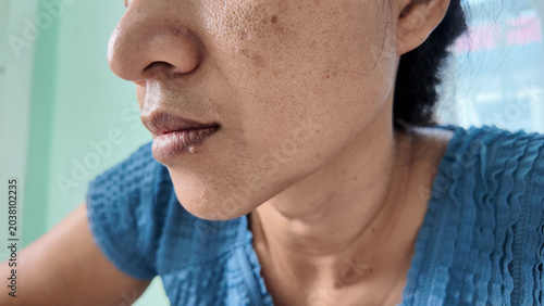 Tableau sur toile Adult woman face skin hyperpigmentation melasma blemish close up side view cheek