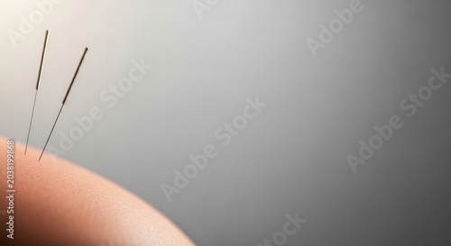 Close-up of Acupuncture Needles Inserted into Human Skin for Alternative Therapy.