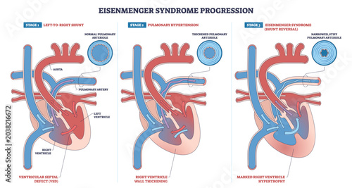 Φωτογραφία Eisenmenger progression, flow shifts from left-to-right shunt to pulmonary hypertension and final shunt reversal, heart, pulmonary artery, arterioles