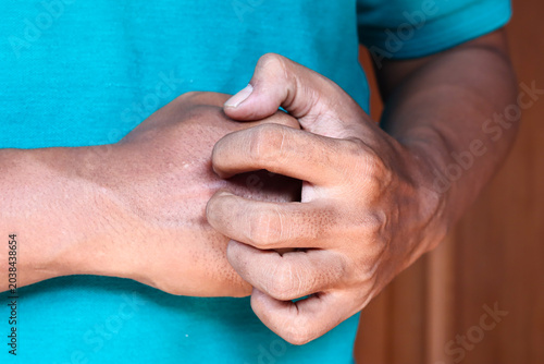 Slika na platnu Asian man's hand Scratching itchy wrist close up