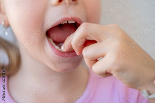 Photos young girl pointing gap in teeth, losing first milk tooth, dental care concept,