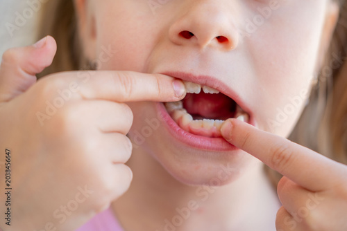 Tableau sur toile young girl pointing gap in teeth, losing first milk tooth, dental care concept,