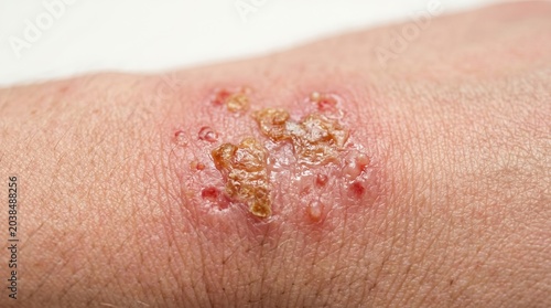 Close-up of Weeping Eczema Impetigo or Shingles Rash with Crusting