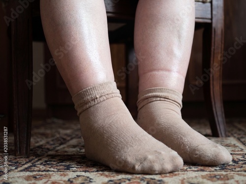 A detail shot of the feet and ankles of an elderly person suffering from chronic heart failure sitting on a chair, the skin taut and ankles visibly swollen with the mark left by the sock's elastic ban
