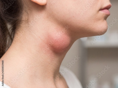 A detail shot of the profile of a young woman's neck affected by acute lymphadenitis, a rounded and reddened swelling the size of a large walnut clearly visible under the jawline, professional photogr