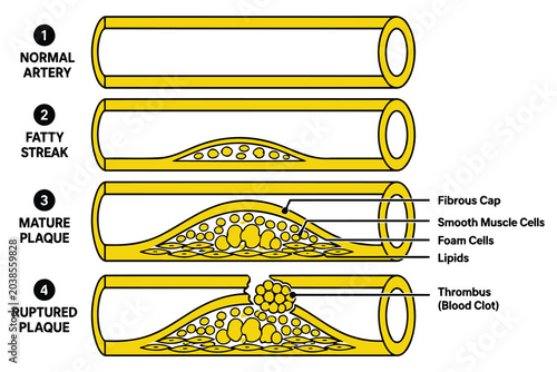 Fotografia Stages of atherosclerosis and plaque formation in artery Vector