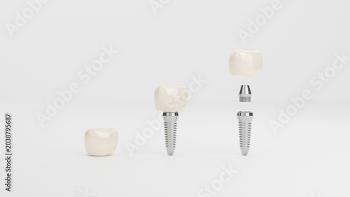Konstfotografi Clean 3D illustration showing dental implant assembly stages with ceramic crowns