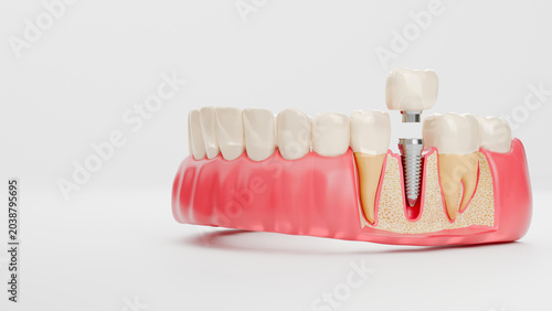 Принти на полотні 3D Three Dimensional Illustration of Dental Implant with Crown Abutment and Cros