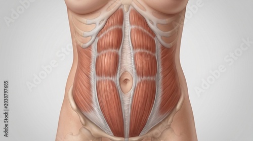 Medical diagram of rectus abdominis divergence (diastasis) on the female body with a detailed display of the structure of muscle bundles and tendon aponeurosis.