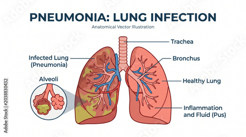Canvas Print Flat pneumonia lung infection isolated on white background, medical vector illus