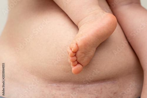 female belly with a scar after cesarean section