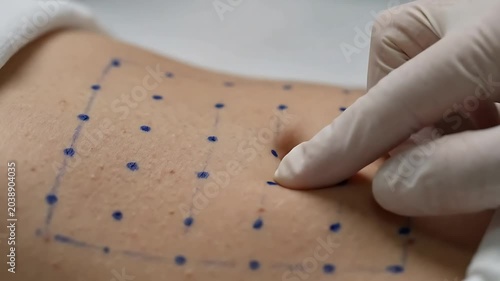 Surgical Grid Markings on Abdomen Skin Before Cosmetic Body Procedure