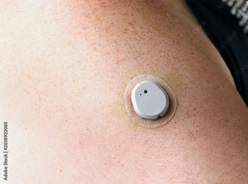 Fototapeta premium Smart Wireless Continuous Glucose Monitor Sensor Patch Close Up on Woman's Upper Arm