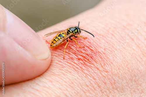 Yellow jacket wasp stinging human skin with red irritation, ideal for first aid, allergy, and insect bite safety content.