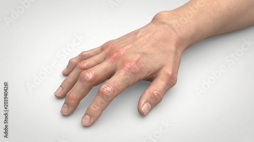 Close up view of a human hand with swollen finger joints and a visible lump on the wrist