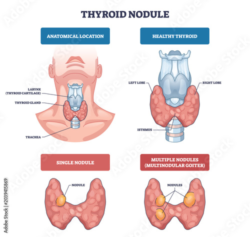 Bilde på lerret Thyroid nodules diagram compares healthy gland and nodule types, showing thyroid gland, larynx, and nodules for quick anatomy insight