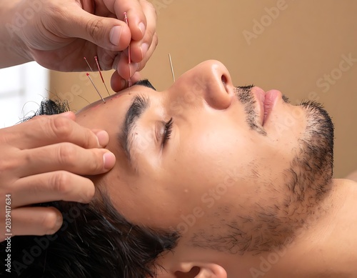 Man receives head acupuncture
