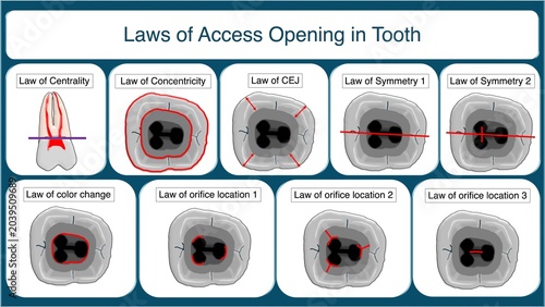 Photos Laws of Endodontic Access Opening in Tooth Chart