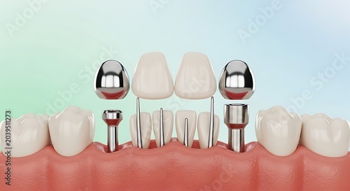 Dental Implants and Crowns Installation Process Close-up.