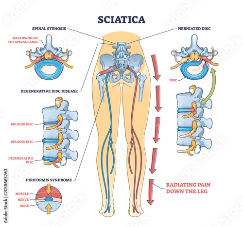 Photos Sciatica pain or nerve weakness as leg lumbar radiculopathy outline diagram, transparent background