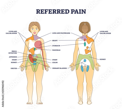 Tableau sur toile Referred pain location as body painful stimulus organ origin outline diagram, transparent background