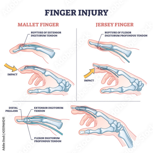 Foto Finger injury types with common hand impact trauma anatomy outline diagram, transparent background