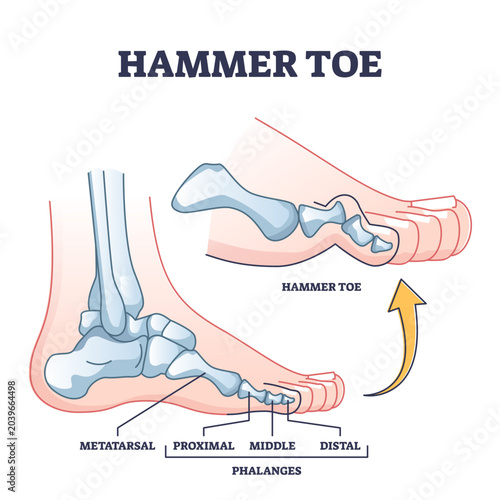 Foto Hammer toe medical problem anatomy with foot phalanges deformation outline diagram, transparent background