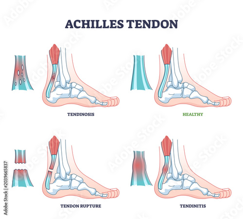 Photos Achilles tendon injury as leg or ankle trauma outline diagram, transparent background