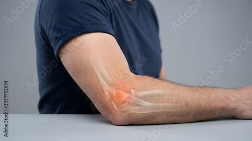 Tennis Elbow Tendon Inflammation and Elbow Joint Pain Medical Illustration