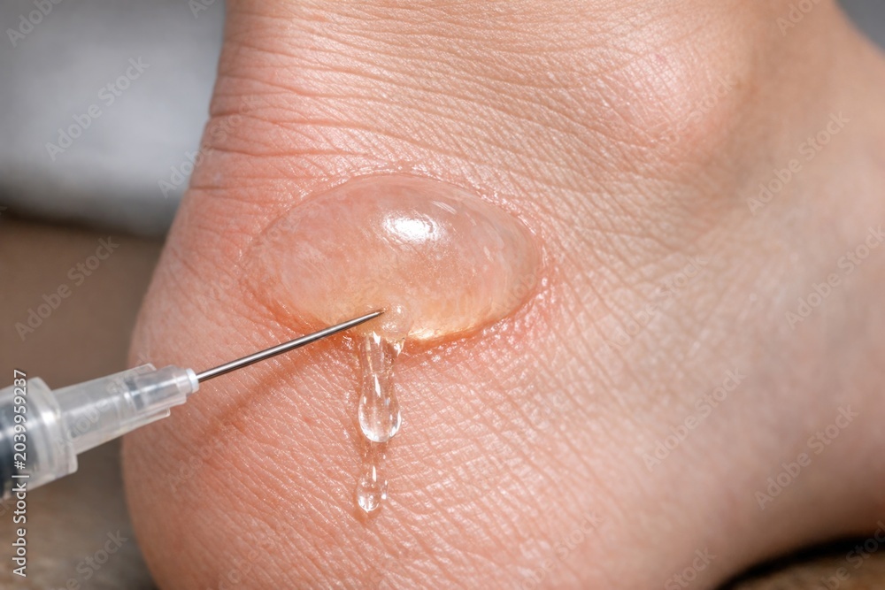 Fototapeta premium A person injured with a needle stuck in their foot, suitable for medical or first aid themed images