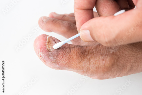 Foot Hygiene Treatment for Fungal Infection