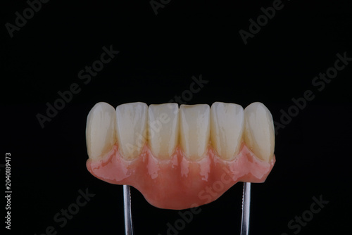 Dental bridge with artificial gum made of zirconium on two titanium abutments to fixation on implant