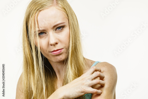Cuadro en lienzo Woman scratching her itchy arm. Skin allergy.