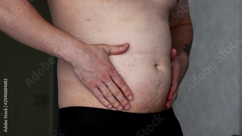 Excess belly fat in a young man.
Demonstration of obesity problems caused by overeating calories.