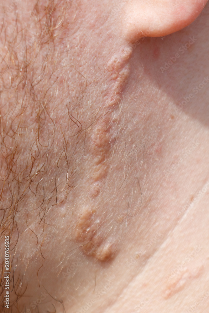Fototapeta premium Close-up of human skin scar near ear