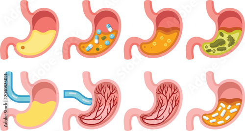 Tableau sur toile Human Stomach Anatomy and Disease Infographic Vector Icon Set with Gastric Acid