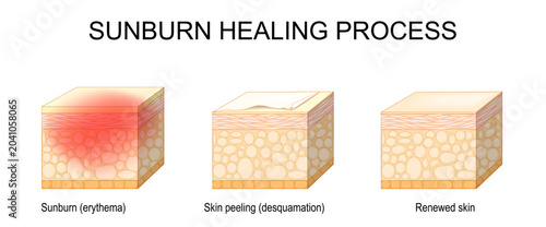 Sunburn healing process from Sunburn erythema and desquamation to Renewed skin. Cross section of human skin. Epidermal homeostasis. Skin peeling