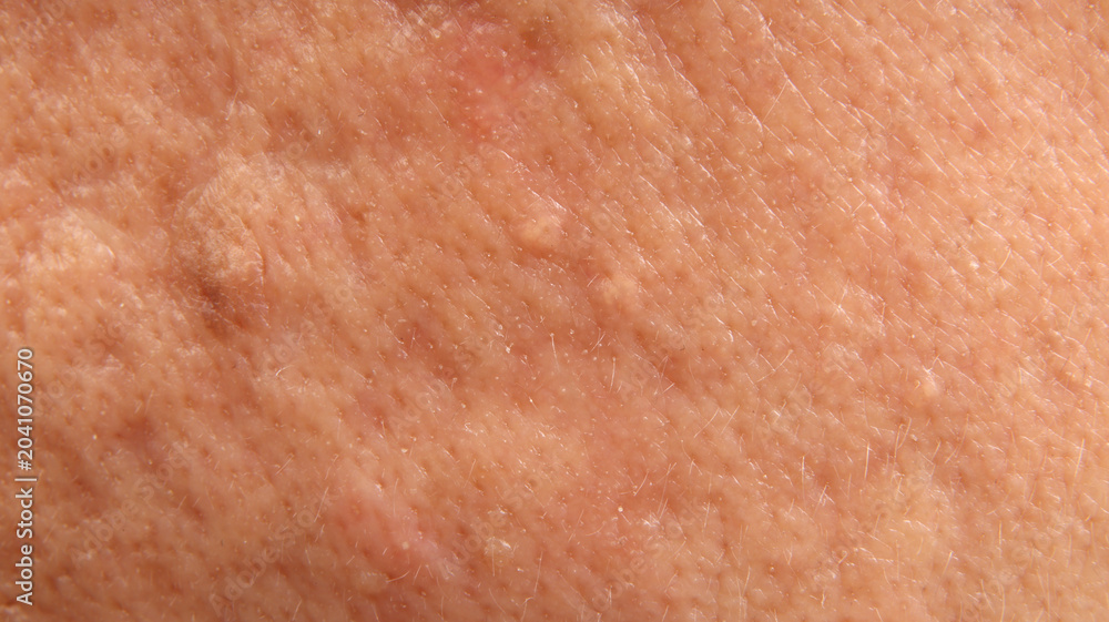 Fototapeta premium Macro closeup of human skin showing a raised mole or skin with visible pores uneven texture
