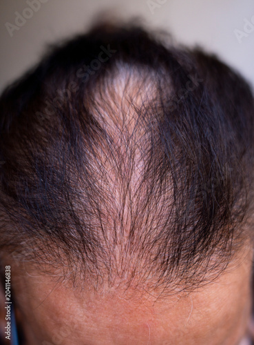 Top view of human head showing progressive hair loss and thinning scalp area with middle aged alopecia thinning dermatology receding follicle wellness clinical treatment medicine condition