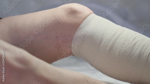Close-up of an elastic bandage on a woman's leg with varicose veins