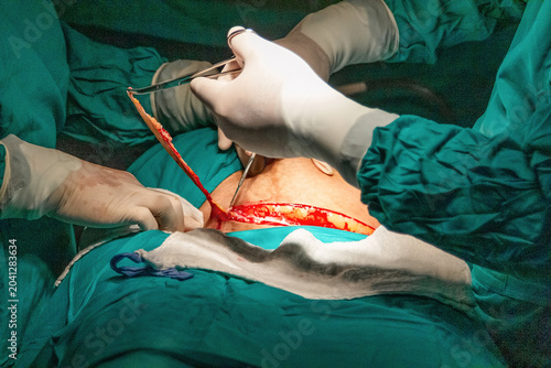 Close-up of cesarean section surgery in progress. Surgeons exposing abdominal tissue through surgical incision during childbirth procedure in hospital operating room.