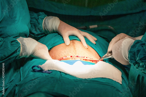 Quadro su tela Cesarean section incision during childbirth surgery in hospital operating room