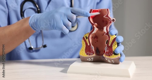Doctor showing model of unhealthy lower rectum with inflamed vascular structures at light wooden table in clinic, closeup