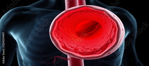 Conceptual 3D rendering of a human artery cross-section with significant plaque accumulation, symbolizing atherosclerosis and critical circulatory health concerns and medical issues